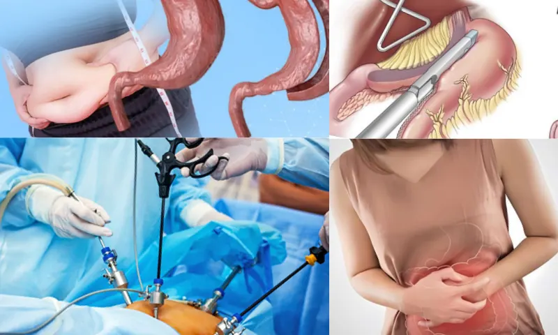 Gastrik Sleeve ile Tüp Mide Ameliyatı Arasındaki Farklar Nelerdir?